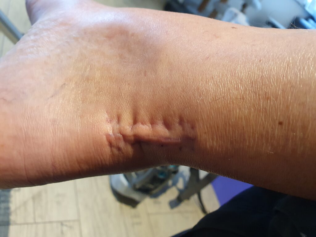 Narbe 6 Wochen nach Fußoperation